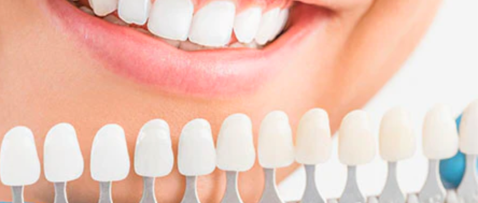 How Much Do Veneers Cost with Insurance