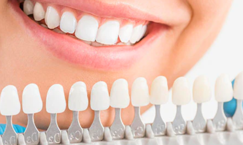 How Much Do Veneers Cost with Insurance