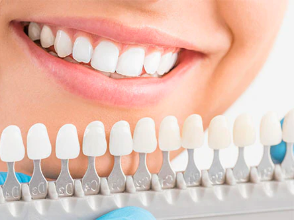 How Much Do Veneers Cost with Insurance?